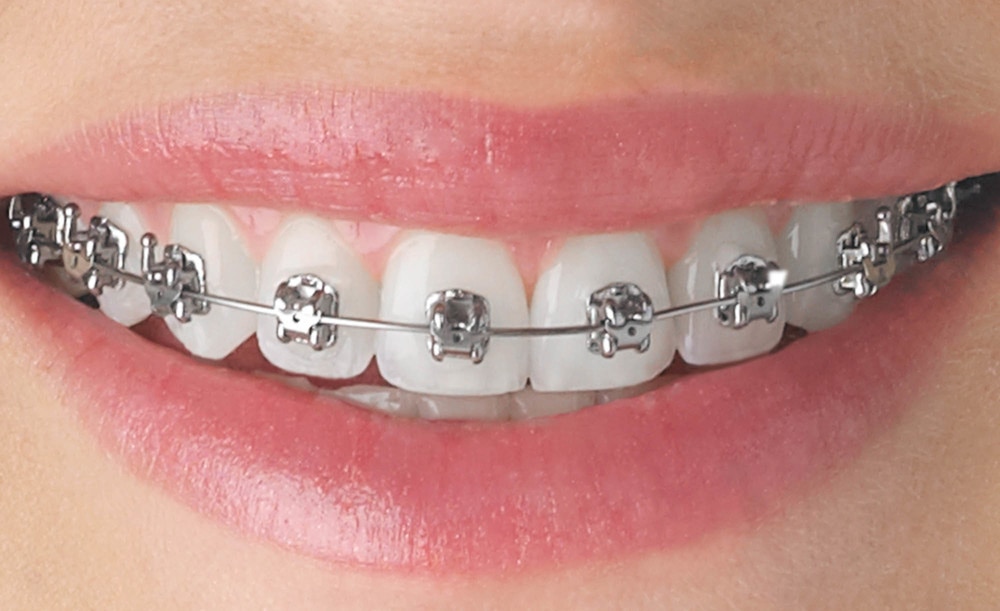 مراحل ارتودنسی دندان 