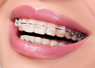ارتودنسی-دندان