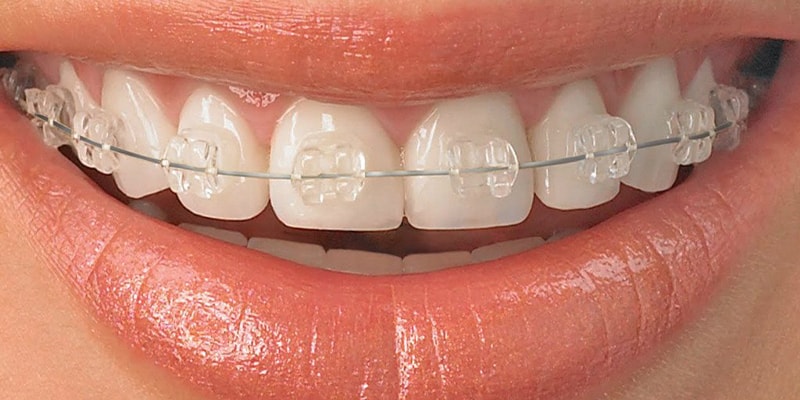 روش های ارتودنسی دندان 