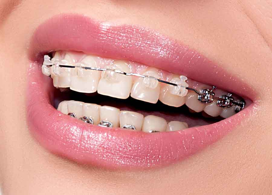 انواع ارتودنسی دندان
