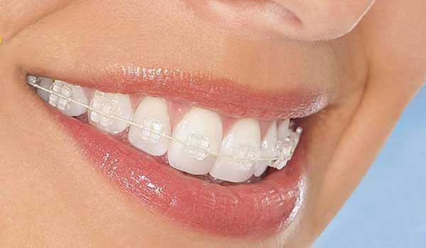 ارتودنسی نامرئی همرنگ با دندانها