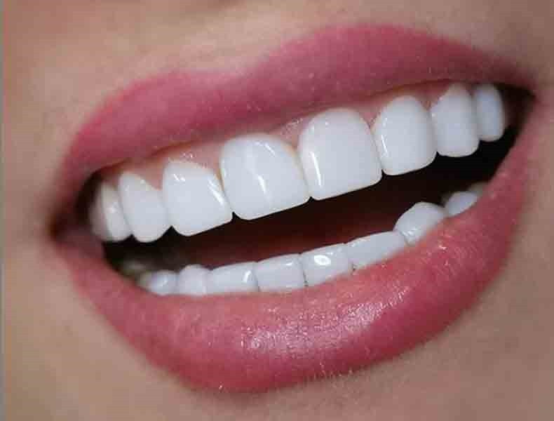 انواع-کامپوزیت-دندان