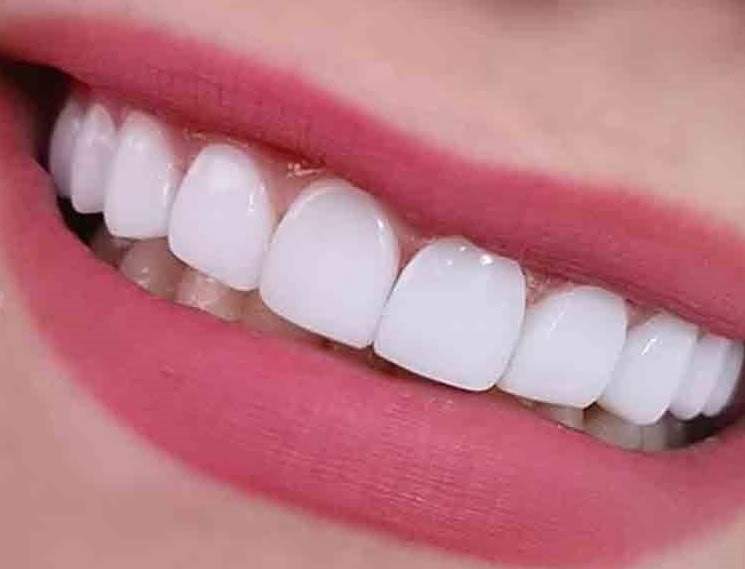 کتمپوزیت-دندان