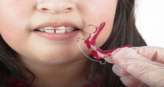 ارتودنسی دندان اطفال