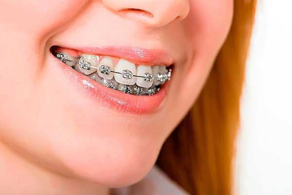 علل نیاز به ارتودنسی دندان