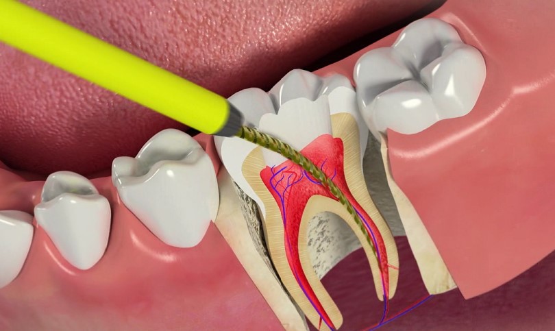 درمان تخصصی ریشه دندان