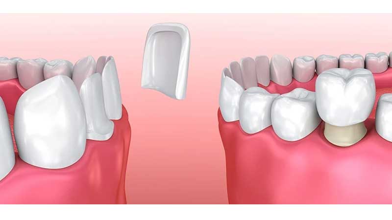 کامپوزیت دندان یا لمینت؟