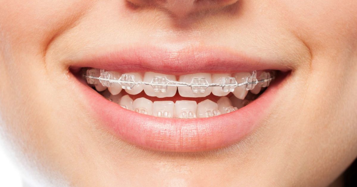 قیمت ارتودنسی دندان