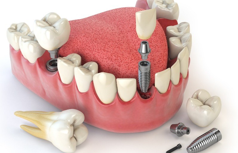 شرایط درمان ایمپلنت دندان