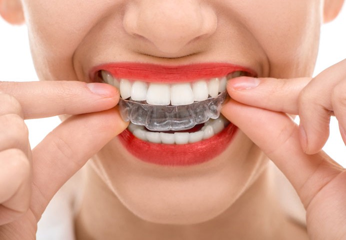 Orthodontics-of-glass-teeth