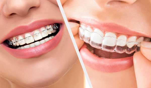 ارتودنسی-دندان-در-کلینیک-قلهک