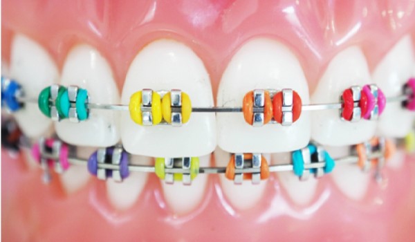 کش-ارتودنسی-دندان