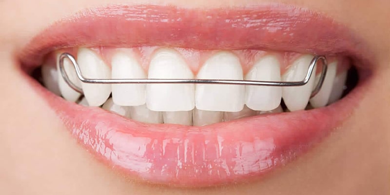 انواع سیم های ارتودنسی دندان