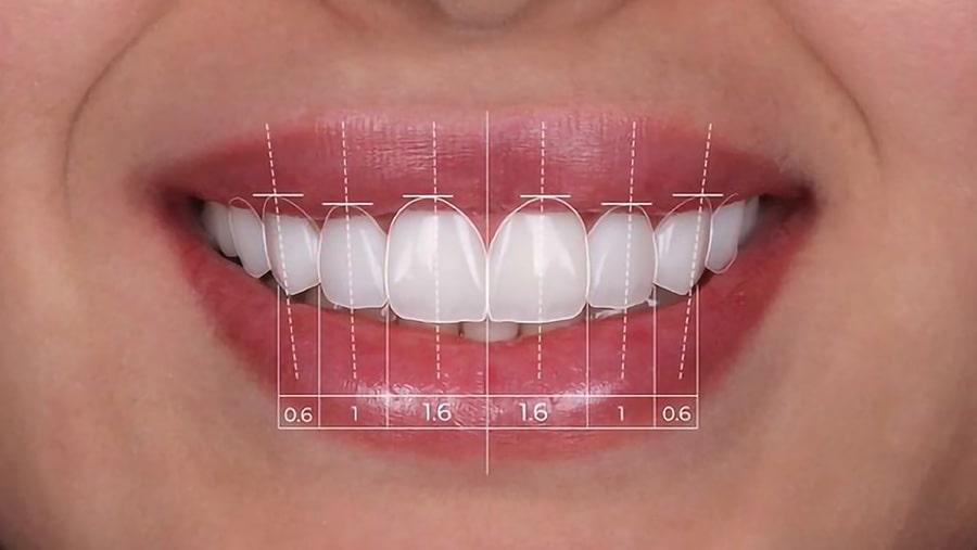 کامپوزیت دندان