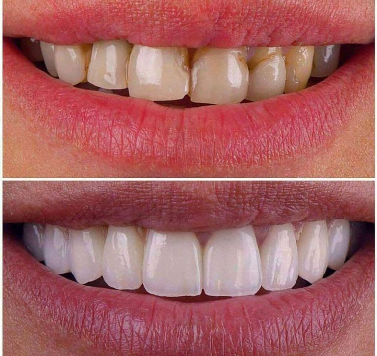 لمینت دندان