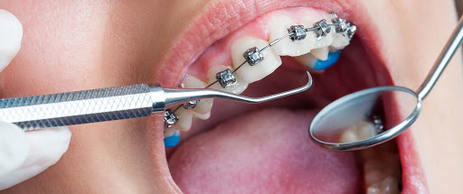 جدا کننده های ارتودنسی دندان