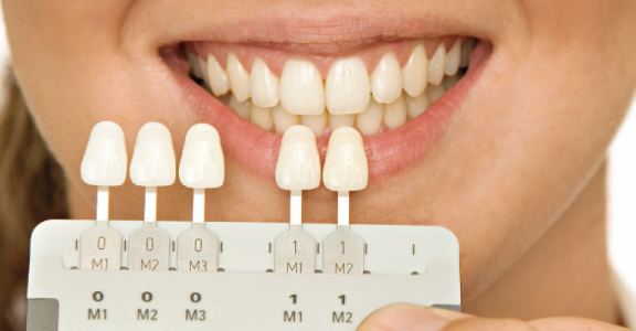  کامپوزیت دندان