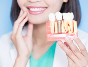 ایمپلنت دندان