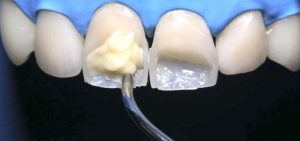 کامپوزیت دندان