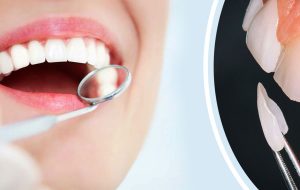 رنگبندی کامپوزیت