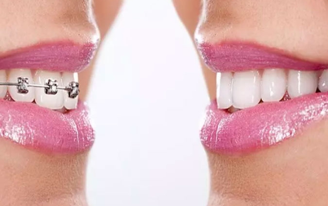 ارتودنسی دندان