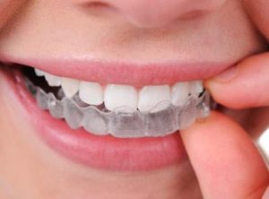 انواع ارتودنسی دندان