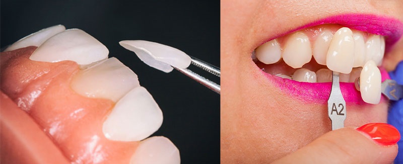 مقایسه کامپوزیت و لمینت