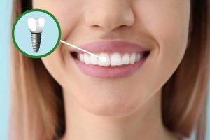 ایمپلنت دندان