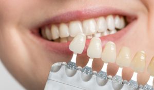 لمینت دندان