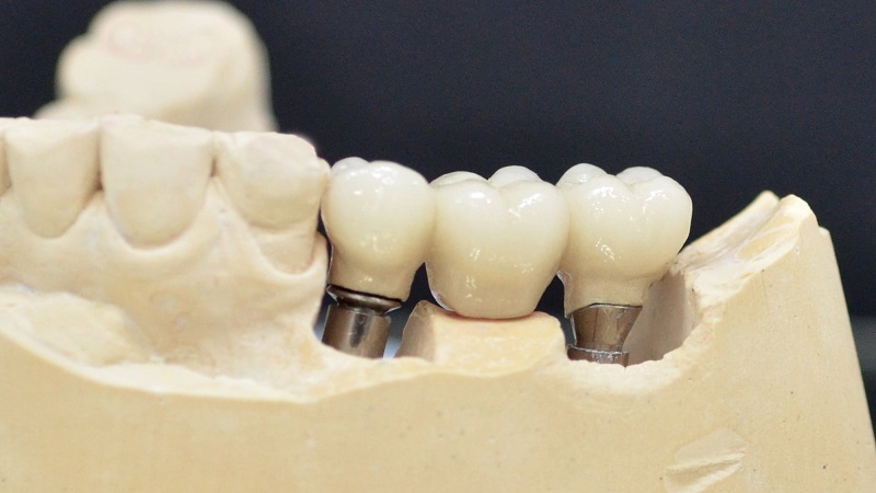 ایمپلنت دندان