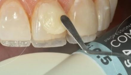 کامپوزیت دندان