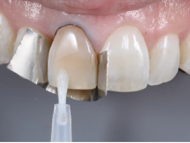 کامپوزیت دندان در قلهک