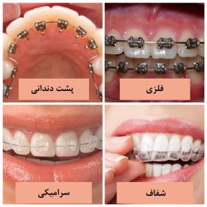 ارتودنسی دندان