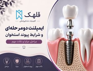 ایمپلنت دندان