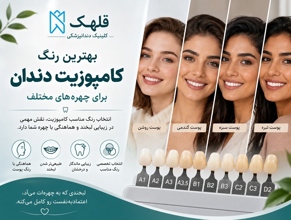 رنگبنذی کامپوزیت دندان