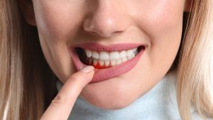 انواع لمینت در دندانپزشکی